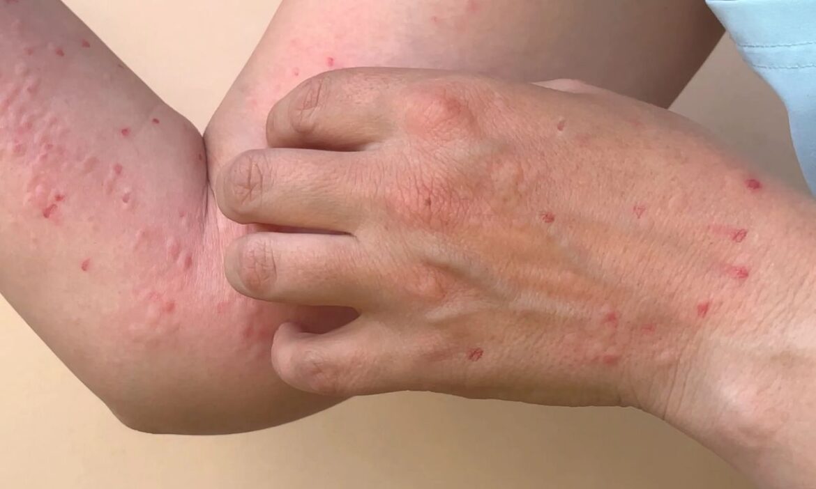 Delhi government alert about Monkeypox symptoms and prevention measures