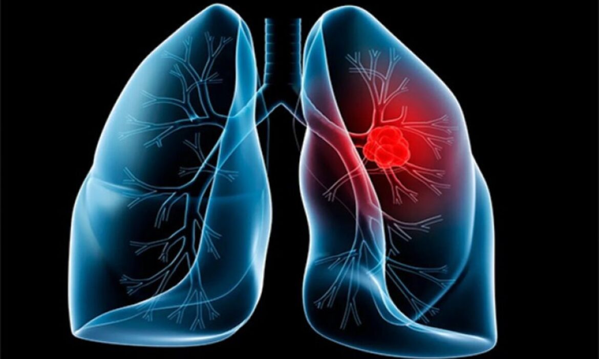 National Pollution Control Day: देश की राजधानी में वायु प्रदूषण के चलते स्वास्थ से जुड़ी परेशानियों का सामना लोगों को करना पड़ रहा है. इस बीच एक्सपर्ट ने फेफड़ों के कैंसर से जुड़ी चेतावनी दी है.