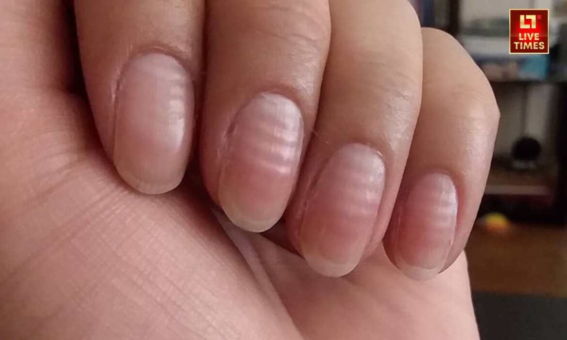 Lines on Nails: नाखूनों पर लाइनें दिखने के कई संकेत हो सकते है. जानिए किन पोषक तत्वों की कमी और बीमारियों से जुड़े हैं ये लक्षण. कहीं किसी बड़ी बीमारी का संकेत तो नहीं.